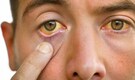 Jaundice causes, symptoms, cure: Watch out for these warning signs of a serious, underlying condition
