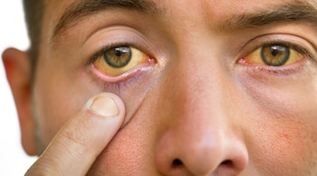 Jaundice causes, symptoms, cure (Image: Canva)