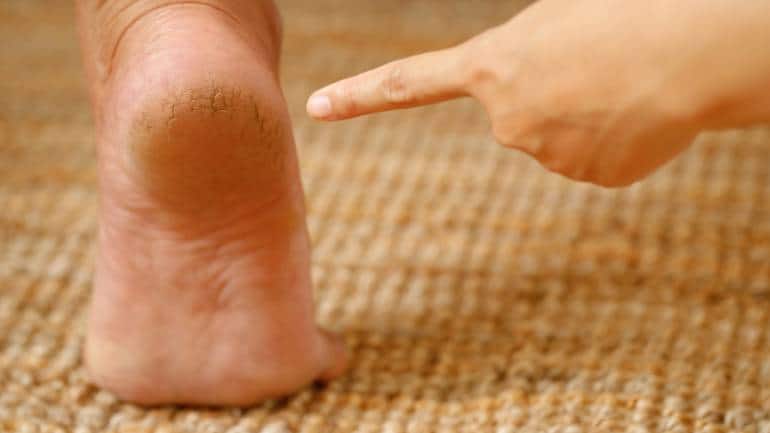 Dry feet and cracked heels: causes and treatment - Salvequick