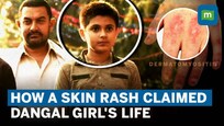 Dangal actress Suhani Bhatnagar death: What is rare skin infection Dermatomyositis? | Explained