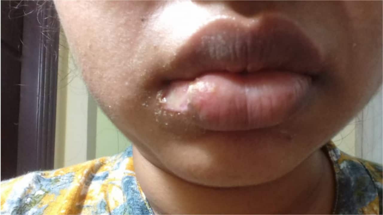 Hyderabad dentist chopped off woman’s lip: ‘Told her she looked good and laughed’