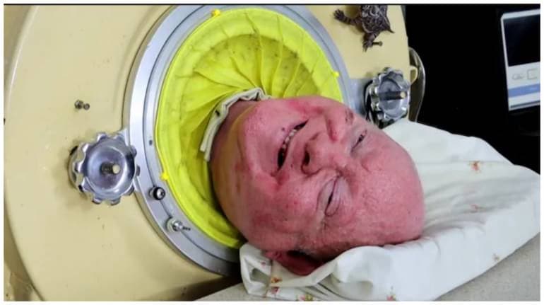 Paralysed polio survivor, who lived in 'iron lung' for 7 decades, dies ...