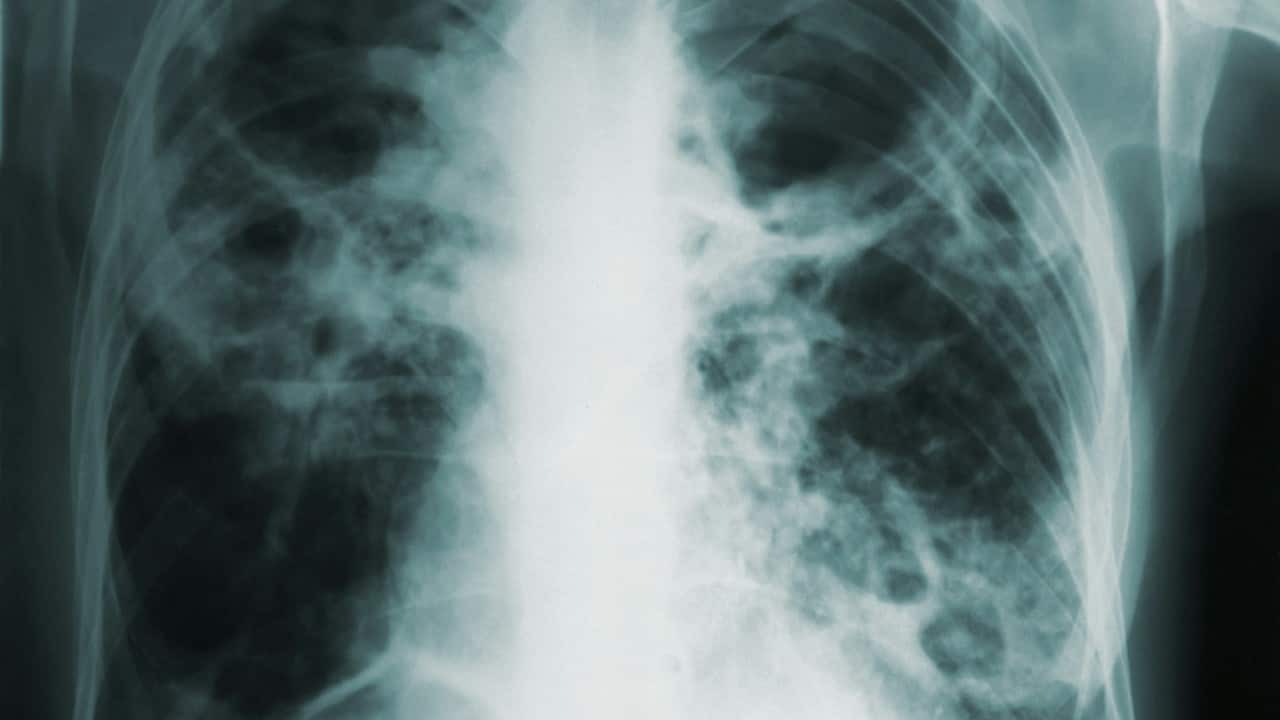 AI can help predict whether a patient will respond to specific tuberculosis treatments, paving way for personalised care AI can help predict whether a patient will respond to specific tuberculosis treatments, paving way for personalised care