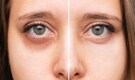 7 home remedies for under-eye dark circles: Try cucumber slices or tomato juice for faster results