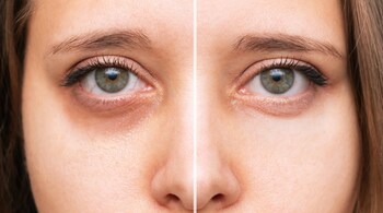 How to get rid of dark circles: Eat diet rich in antioxidants, vitamins (especially vitamin K), and minerals to support skin health and reduce inflammation (Image: Canva)