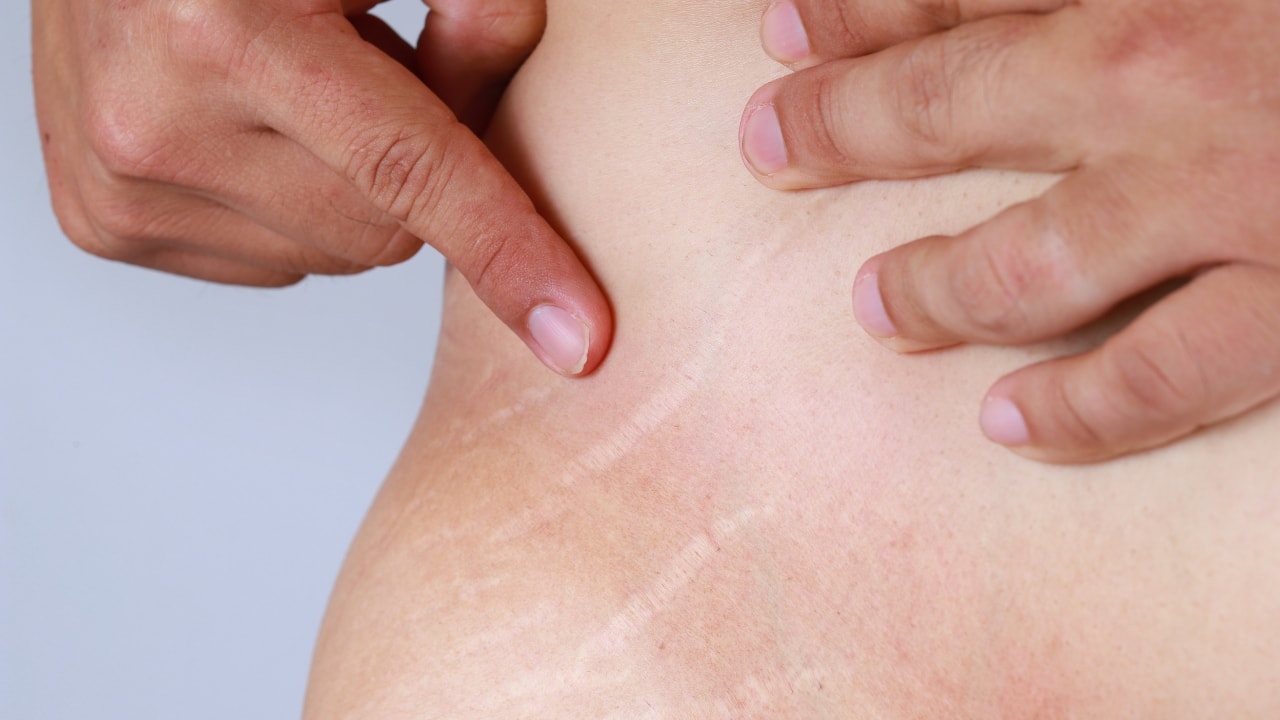 Stretch marks killing your confidence? Follow these tips to get rid of those pesky streaks