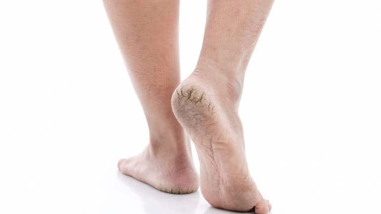 With summer's heat and increased exposure to outdoor elements, your heels require extra attention to stay soft, smooth, and free of discomfort. Try these 7 ingredients to help heal dry skin and cracked heels (Image: Canva)