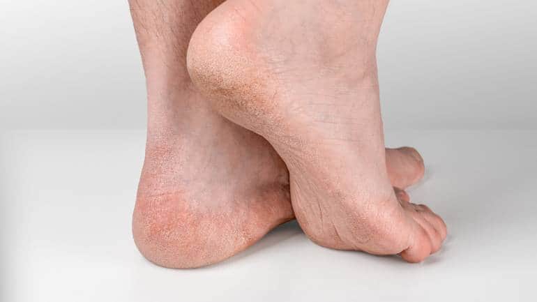Home remedies for dry, cracked heels: Heal it with the health benefits of honey, aloe vera, Epsom salt