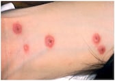 Woman gets painful rashes, scales after ibuprofen dose. What is the Stevens-Johnson Syndrome?