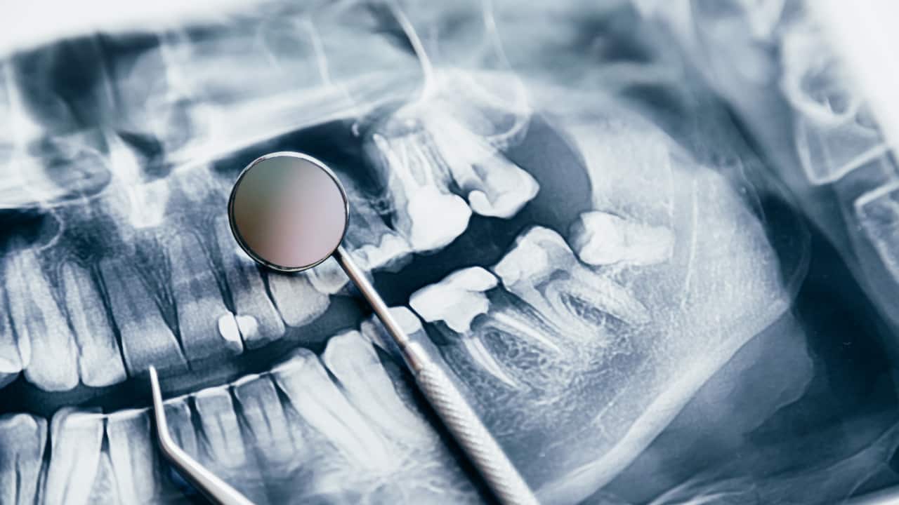 Symptoms, causes of oral cancer: Smoking, alcohol, HPV infections