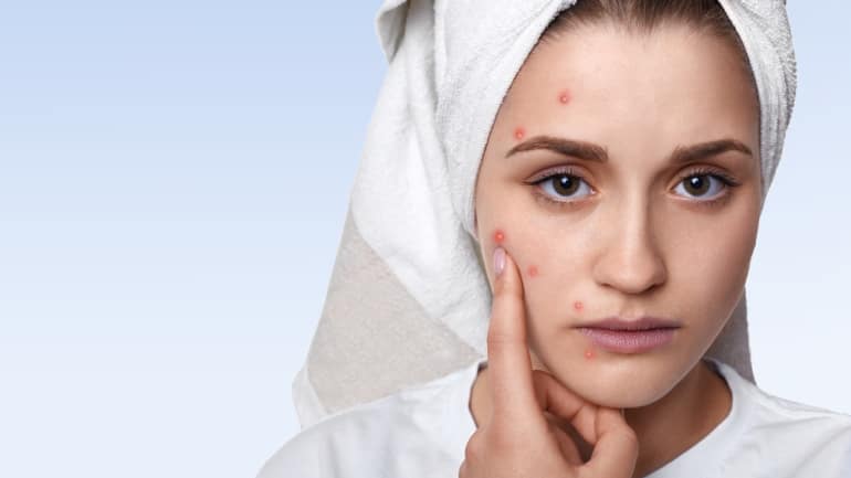 Acne Scar Treatment in Pune - Eva Skin Clinic