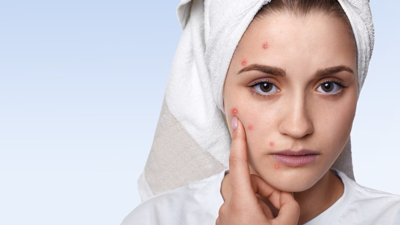 Stress: Acne breakouts, dullness and hair loss are signs your skin reflects mental strain