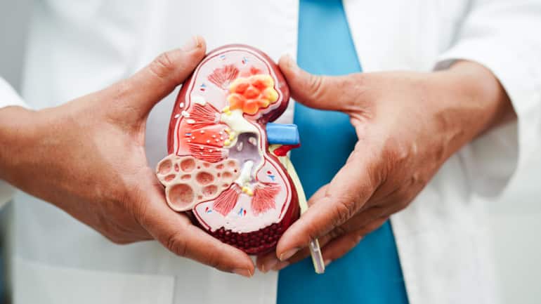 Causes of kidney cancer: Obesity elevates blood pressure and changes hormone levels, these conditions create the perfect storm for kidney cell mutations (Image: Canva)