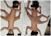 How surgeons helped extremely rare conjoined 'spider twins' born with 3 legs &amp; 4 arms