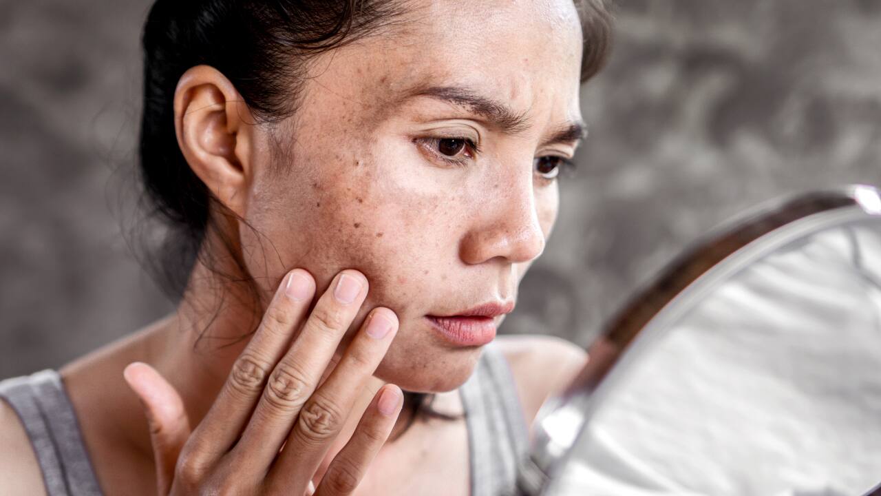 Skin pigmentation: Causes, risks and 6 effective home remedies to reduce it
