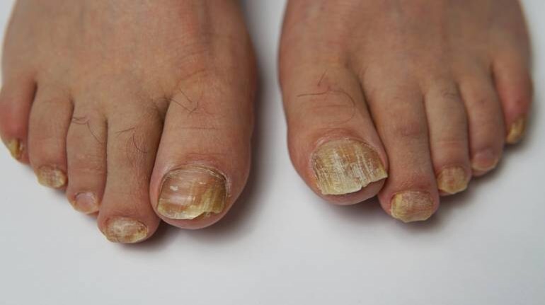 Home Remedies For Toenail Fungus: Use Garlic, Coconut Oil, Baking Soda 