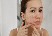 Difference between acne and fungal skin issues, everything you need to know