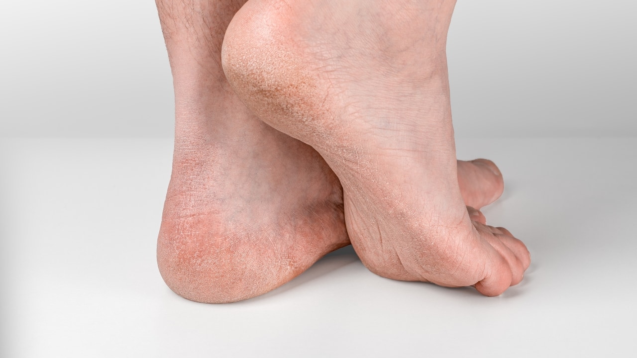 All about ichthyosis: Use retinoids, humidifiers, moisturisers to manage this skin disorder