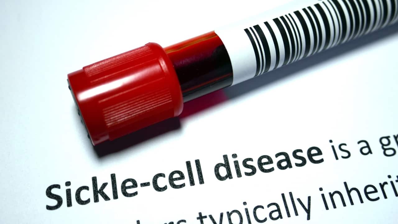 World Sickle Cell Day 2024: Types, causes, symptoms and treatment for this genetic disorder