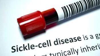 Sickle Cell Disease Day 2024: Symptoms of SCD typically begin around six months of age and can vary greatly in severity among individuals (Image: Canva)