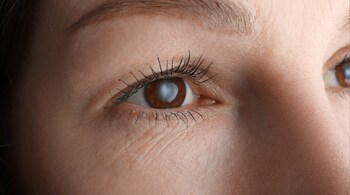 Cataracts in younger adults: Vision may become hazy, making it difficult to see clearly. (Image: Canva)