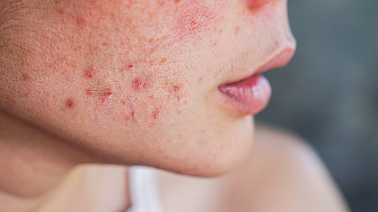 All about hormonal acne: Causes, symptoms and treatment strategies