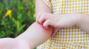 Symptoms of arthritis in children: Fever and skin rashes are linked to certain forms of juvenile arthritis (Image: Canva)