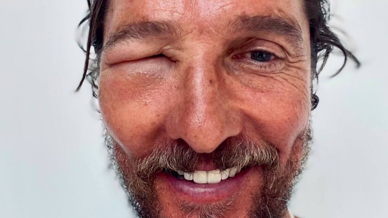 Matthew McConaughey doesn’t seem ‘alright, alright, alright’ after a bee sting, shares picture