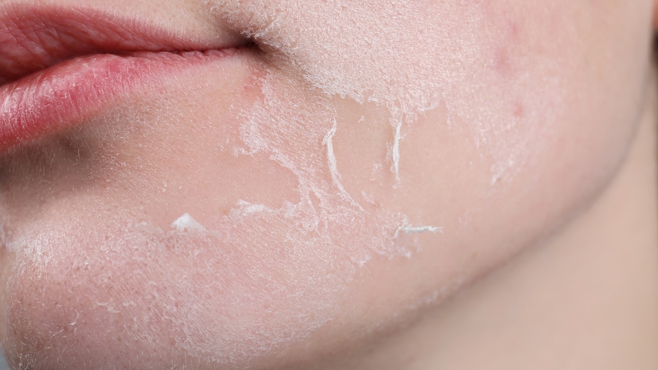 Symptoms of perioral dermatitis: Burning sensation, dryness, rashes and others