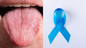 Early signs of mouth cancer can sometimes be subtle but important to recognize. (Image: Canva)