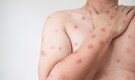 Africa's top health body declares mpox a continental health emergency