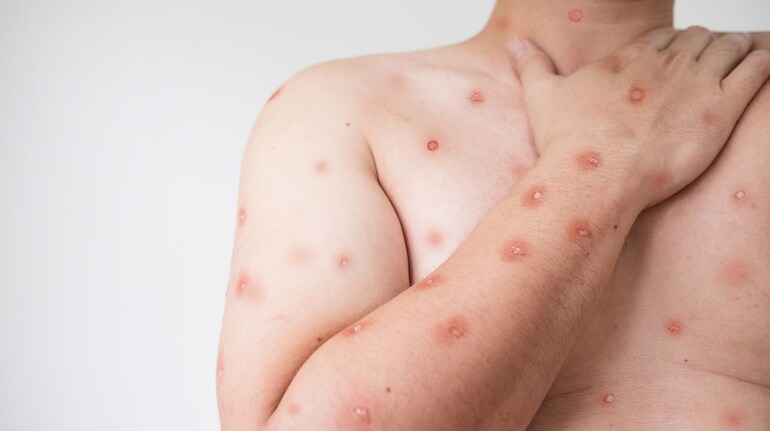 Mpox symptoms in children: Address headaches, fatigue, muscle aches, fever  immediately