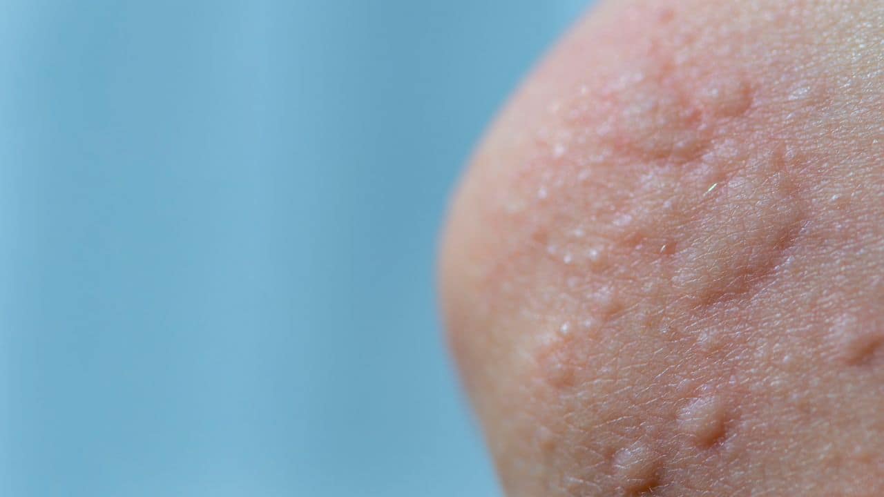 Do you have diabetes? Here's why you should be worried about shingles