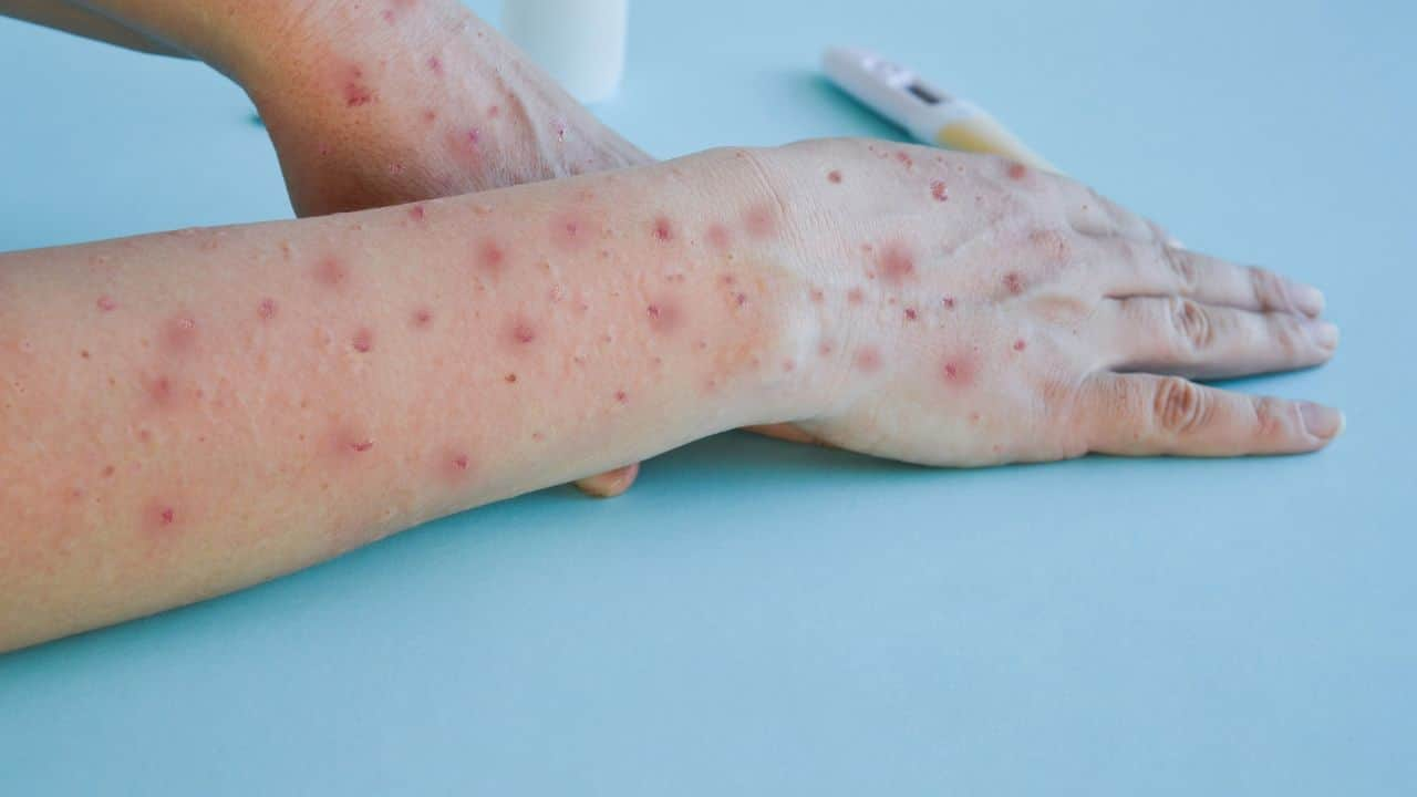 Monkeypox symptoms Dos and don'ts if you are diagnosed with this viral