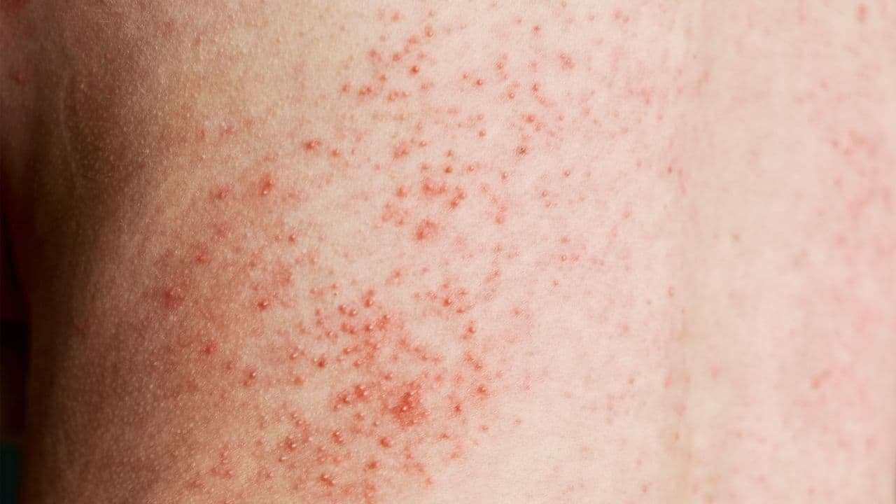Seasonal skin rashes: Prevent heat rash, hives, fungal infections with these expert tips