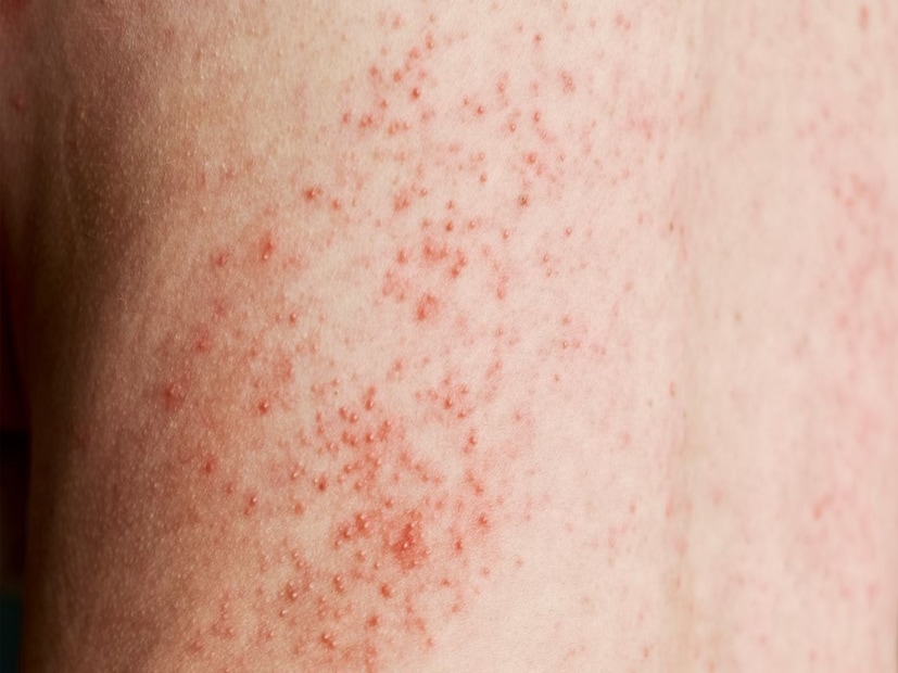 Heat Rash Pinoy Summer Heat Rash: చెమట గడ్డలు, రాషెస్తో బాధపడుతున్నారా?.. పైసా కూడా ...