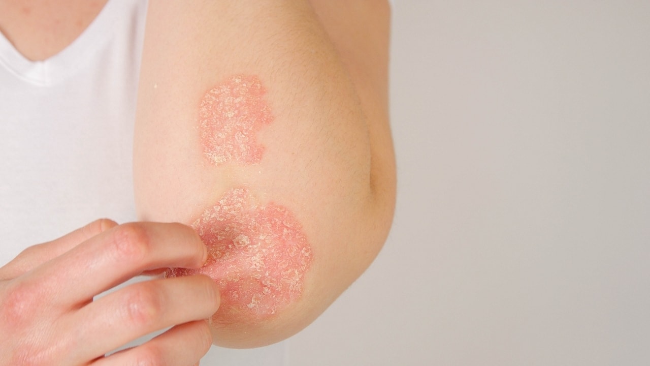 Symptoms of eczema: Expert tips to cure itching, dry and scaly skin, redness, swelling