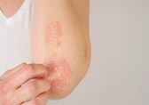 Symptoms of eczema: Expert tips to cure itching, dry and scaly skin, redness, swelling