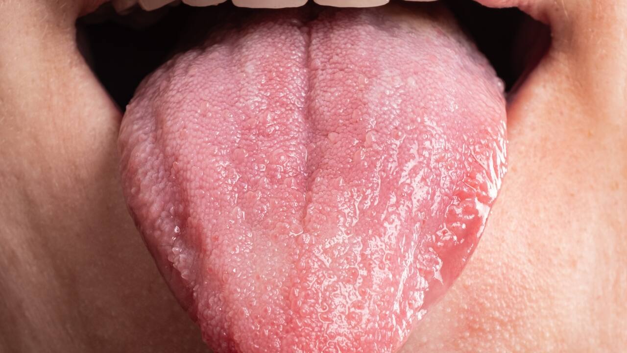 Pain, lump in neck, red patches could be symptoms of tongue cancer, here's what you should know