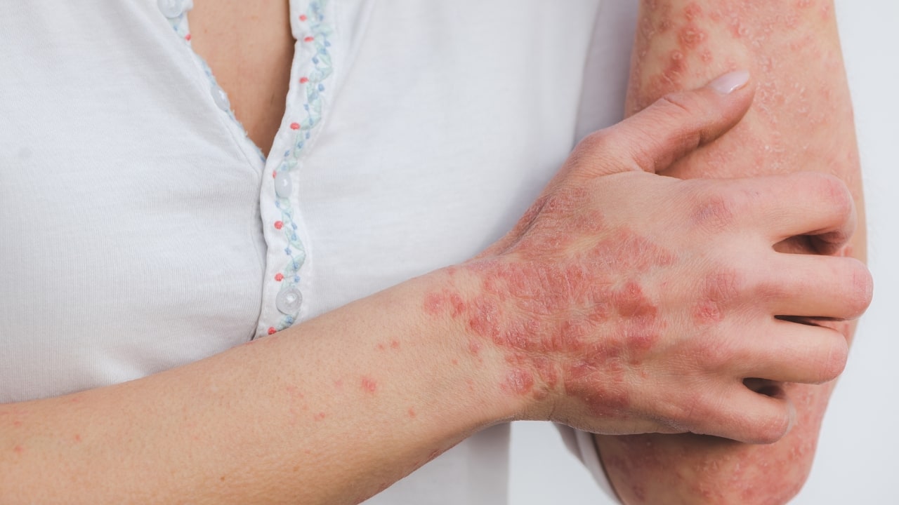 What is psoriasis, types and symptoms of this chronic skin condition, home remedies to manage