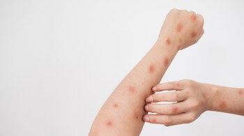 Mpox causes various types of skin lesions, including macules, papules, vesicles, pustules, and crusts. (Image: Canva)