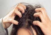 Soothe itchy scalp: Use mild shampoos, aloe vera, and more to prevent fungal infections, scratchy skin