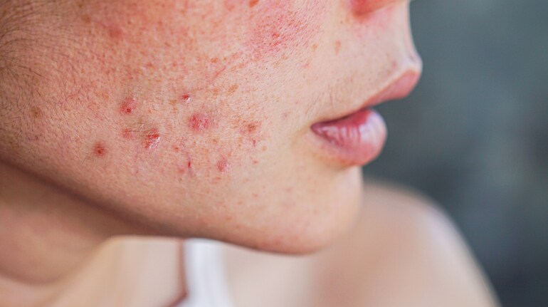 Acne during periods? Here's what you should know to prevent breakouts ...