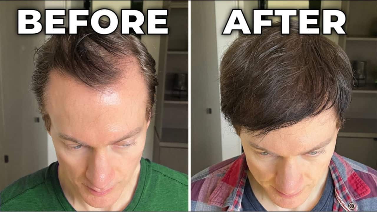 'Genetically, I should be bald': Anti-aging millionaire Bryan Johnson reveals how he grew his hair back