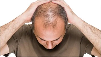 Panic in 3 Maharashtra villages as people suffer from sudden hairfall, over 30 bald within a week