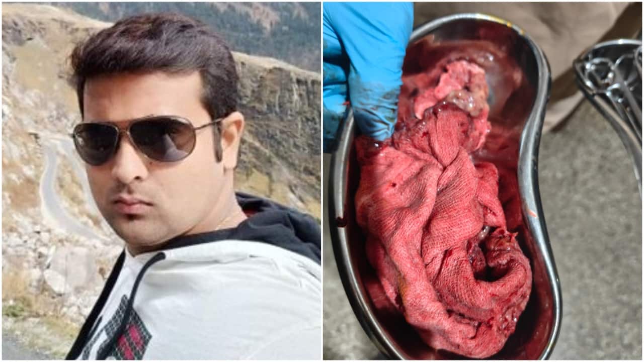 Man says doctor left mop inside wife's stomach after C-section delivery. 'Spent lakhs on treatment'