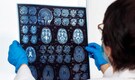 Plastic spoons' worth of plastic found inside your brain, new study raises alarm