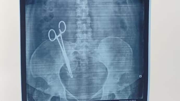 Scissors left in a woman’s stomach after a C-section removed after 17 years
