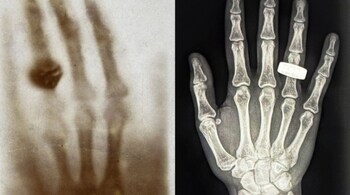 On the left is the first medical X-ray from 130 years ago, while the image on the right shows the first-ever X-ray taken in space—a scan of an astronaut’s hand wearing a ring. (Image: MIT)