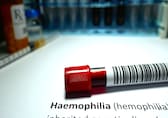 World Hemophillia Day 2025: Early symptoms of pediatric hemophilia parents shouldn't ignore